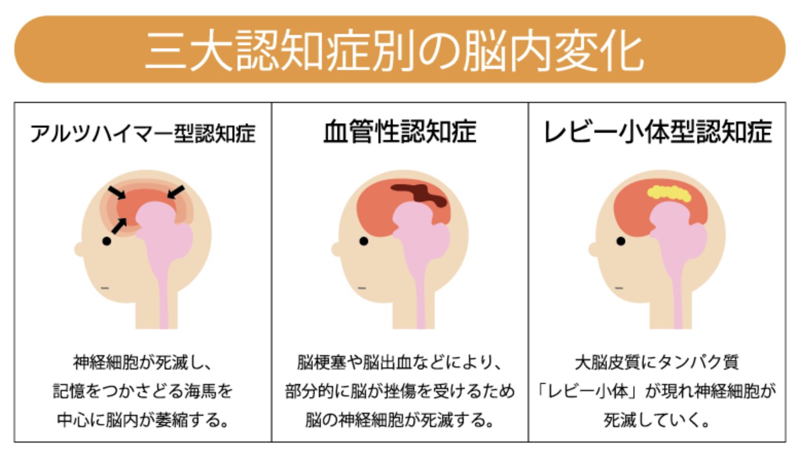 認知症が一気に進む？進行速度や寝たきり状態について徹底解説！│健達ねっと