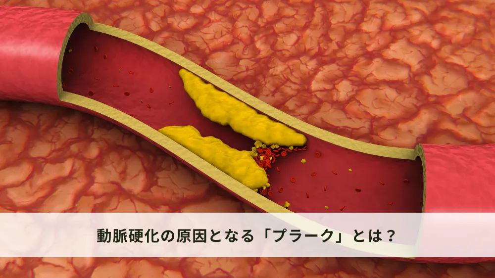 動脈硬化の直接的原因「プラーク」について